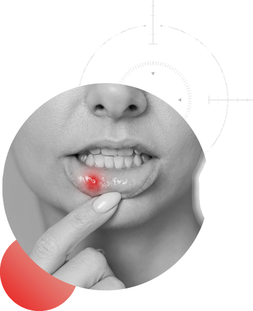 Nærbilde av munn med smertefullt munnsår – typisk symptom på aftesår som kan behandles med Oralmedic